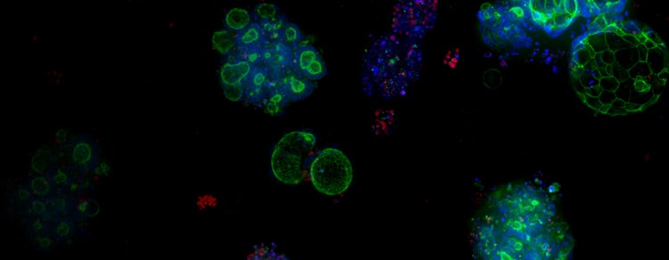 Organoidi di carcinoma del colon-retto (CRC)