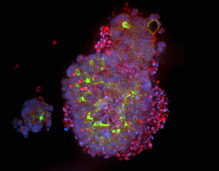 Organoidi di carcinoma del colon-retto derivati da pazienti