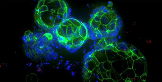 Organoidi di carcinoma del colon-retto