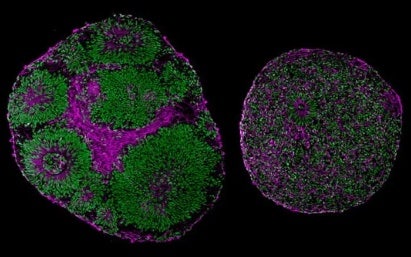 Metodi di modellazione delle malattie con organoidi derivati da pazienti oncologici