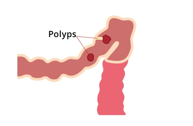 FAP e MAP sono condizioni ereditarie che possono portare alla formazione di centinaia o migliaia di polipi colorettali (immagine di Guts UK Charity)